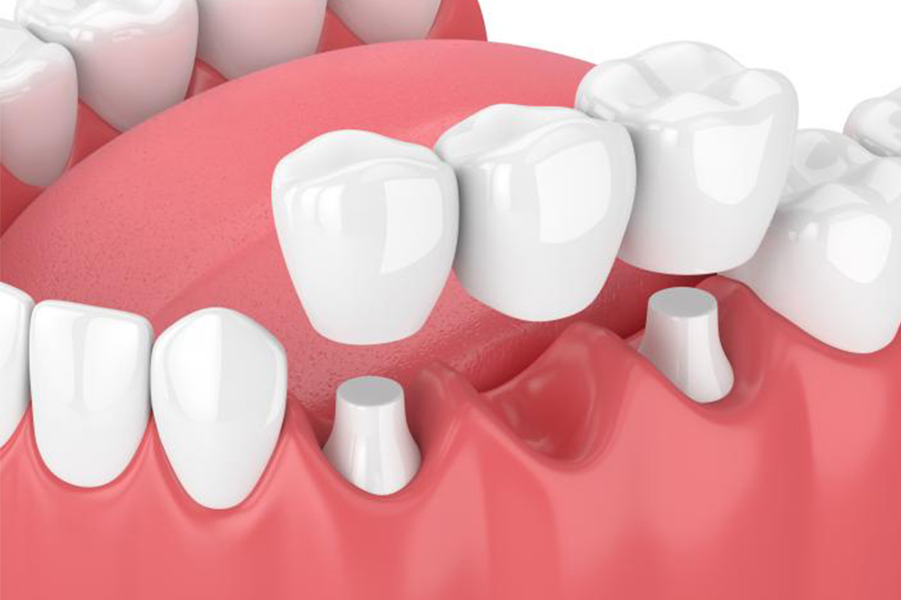 A Comprehensive Guide to Dental Crowns and Bridges