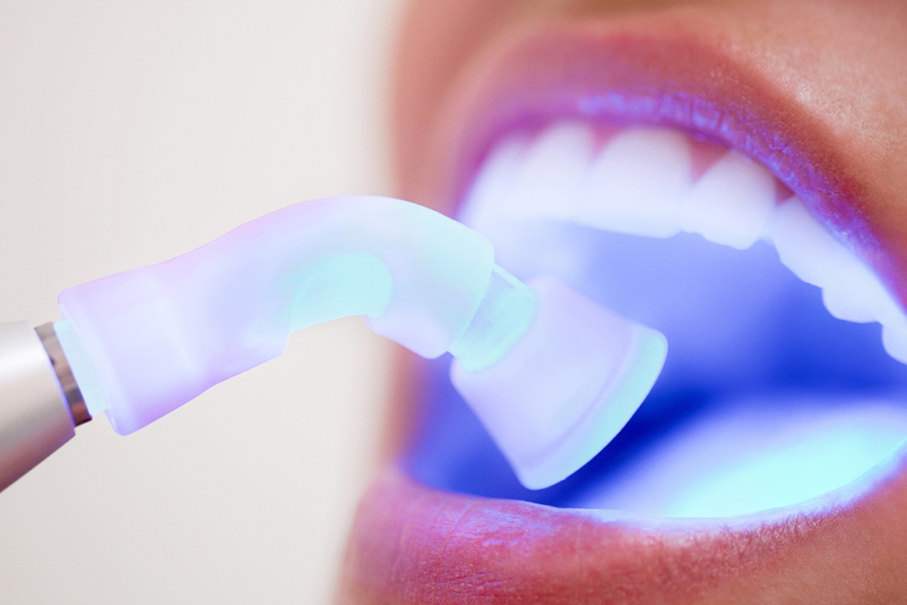 Dental Bonding Durability: 7 Tips to Extend the Life of Your Treatment