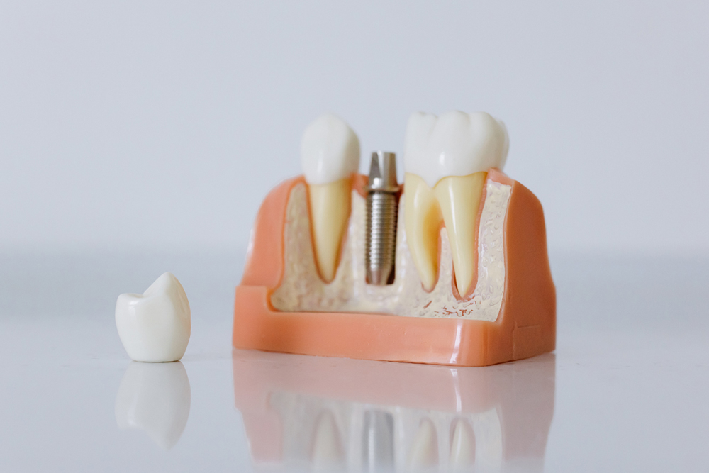 Dental Implants Complete Guide: What Patients Need