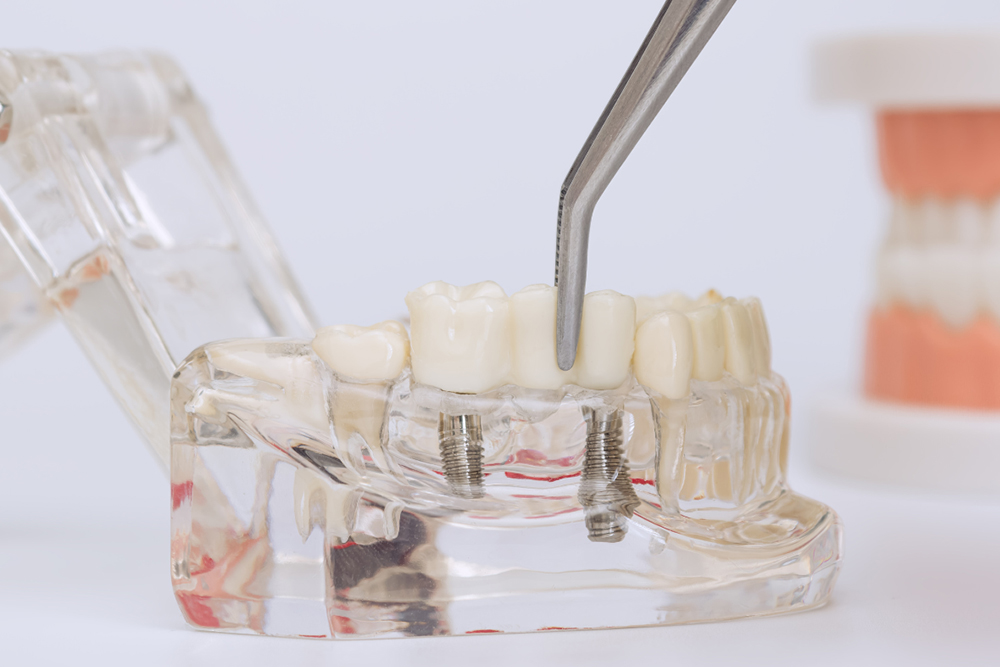 Dental Implants Failure: Warning Signs and Prevention