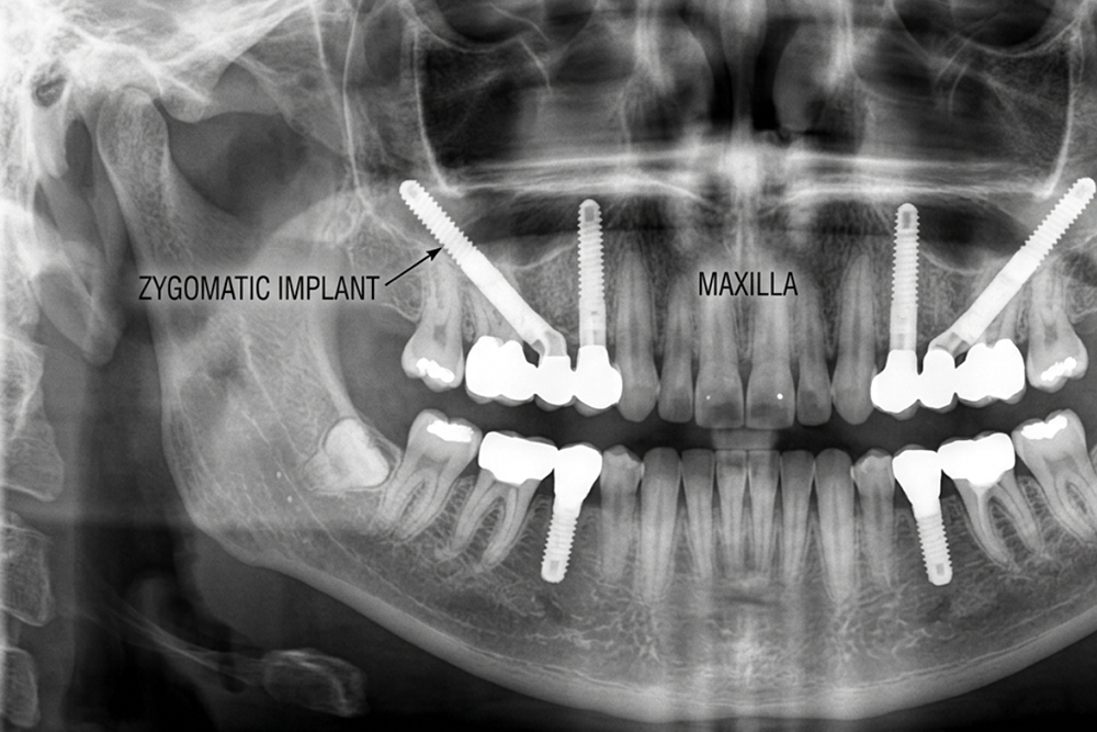 Zygomatic Dental Implants for Severe Bone Loss
