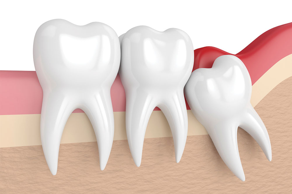 Everything You Need to Know About Wisdom Teeth