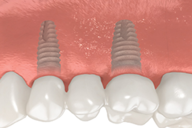 Understanding Dental Implants: A Modern Solution for Restoring Your Smile