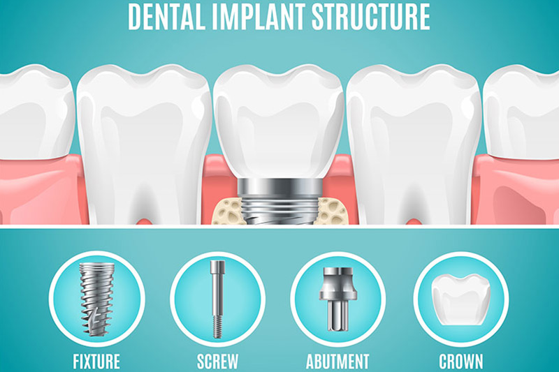 Vaughan Dental Implants: What to Expect